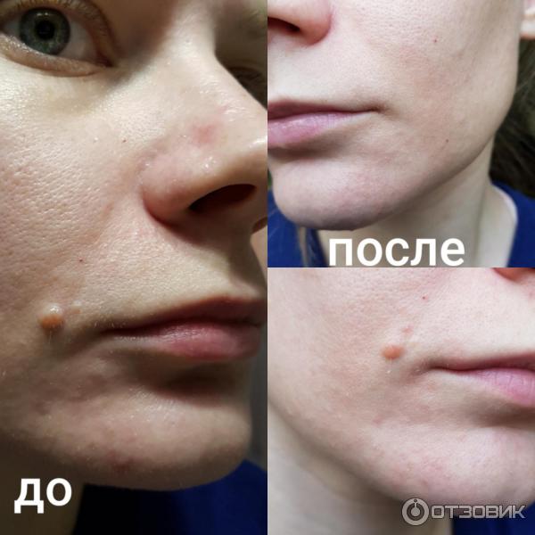 микроотшелушивающий гель La Roche-Posay