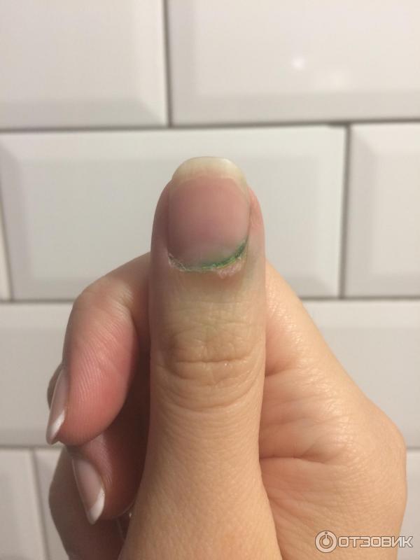 Как лечить панариций пальца