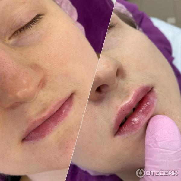 Губы сардиния до и после