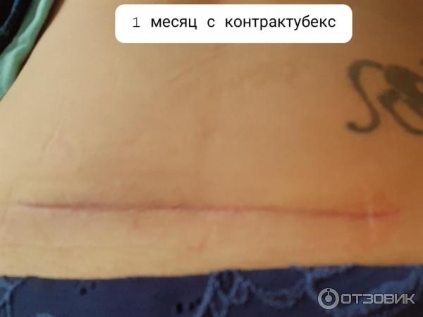 Отзыв о Пластырь от рубцов Merz Контрактубекс | После кесарева эффект есть