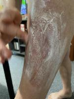 Мазь для наружного применения от псориаза Qicun baxian фото